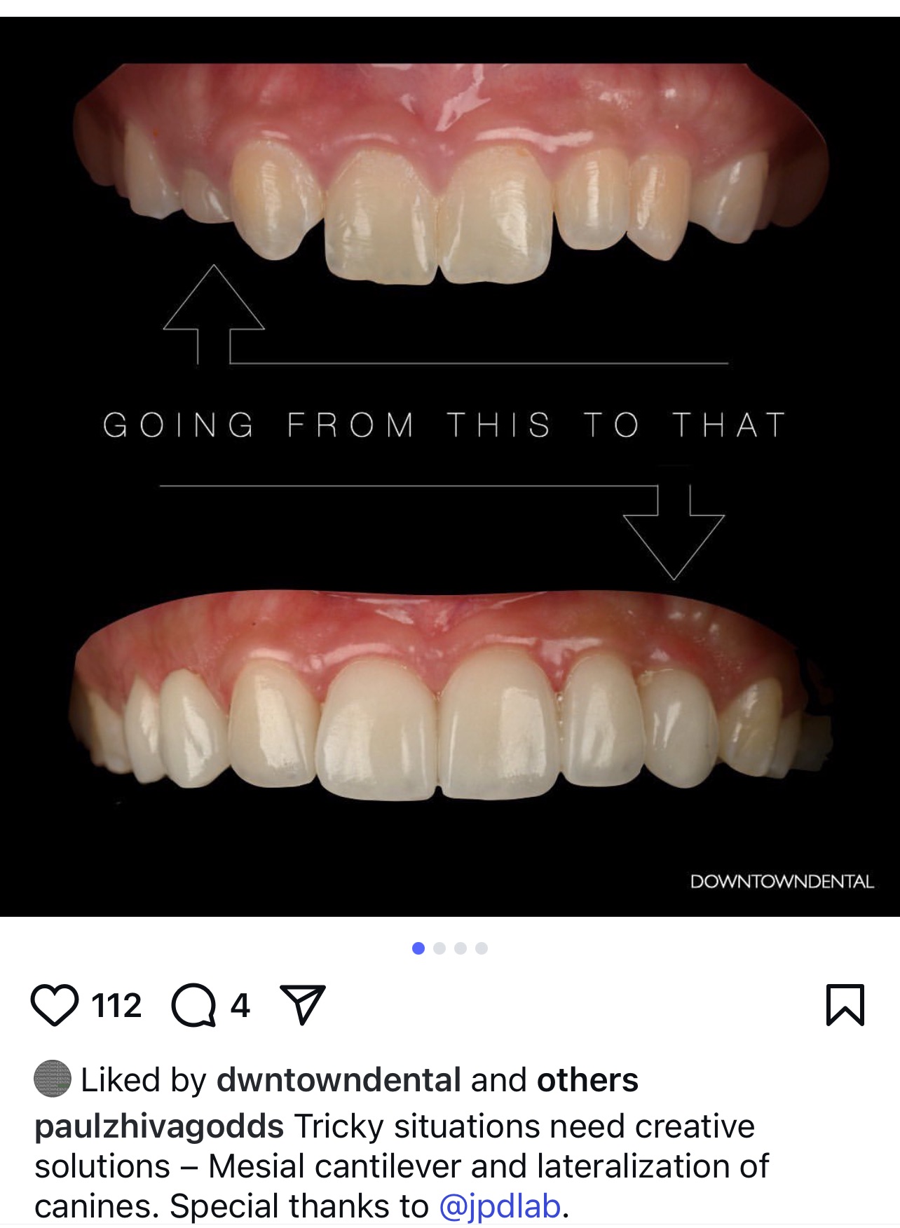 All-Ceramic Restoration